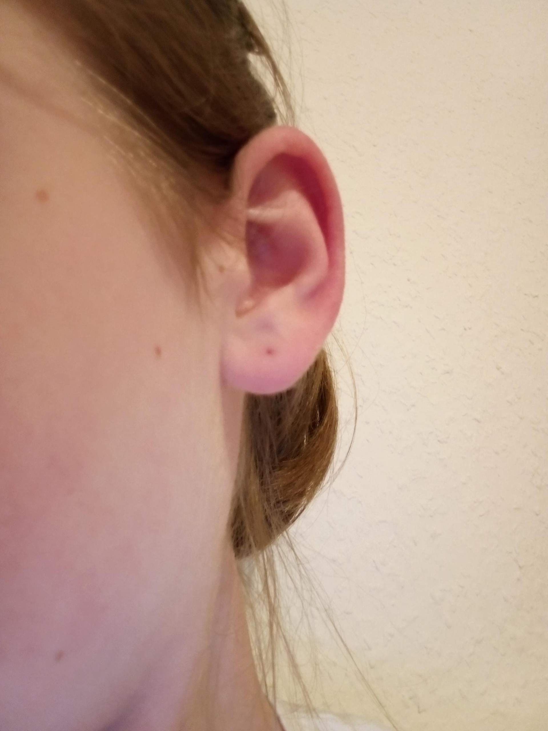 Wie Schnell Wächst Ein Ohrloch Zu Ohrloch entzündet? (Ohrringe)
