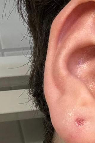Ohrloch rötlich nach schiessen? (Piercing, Entzündung, Ohrloch stechen)