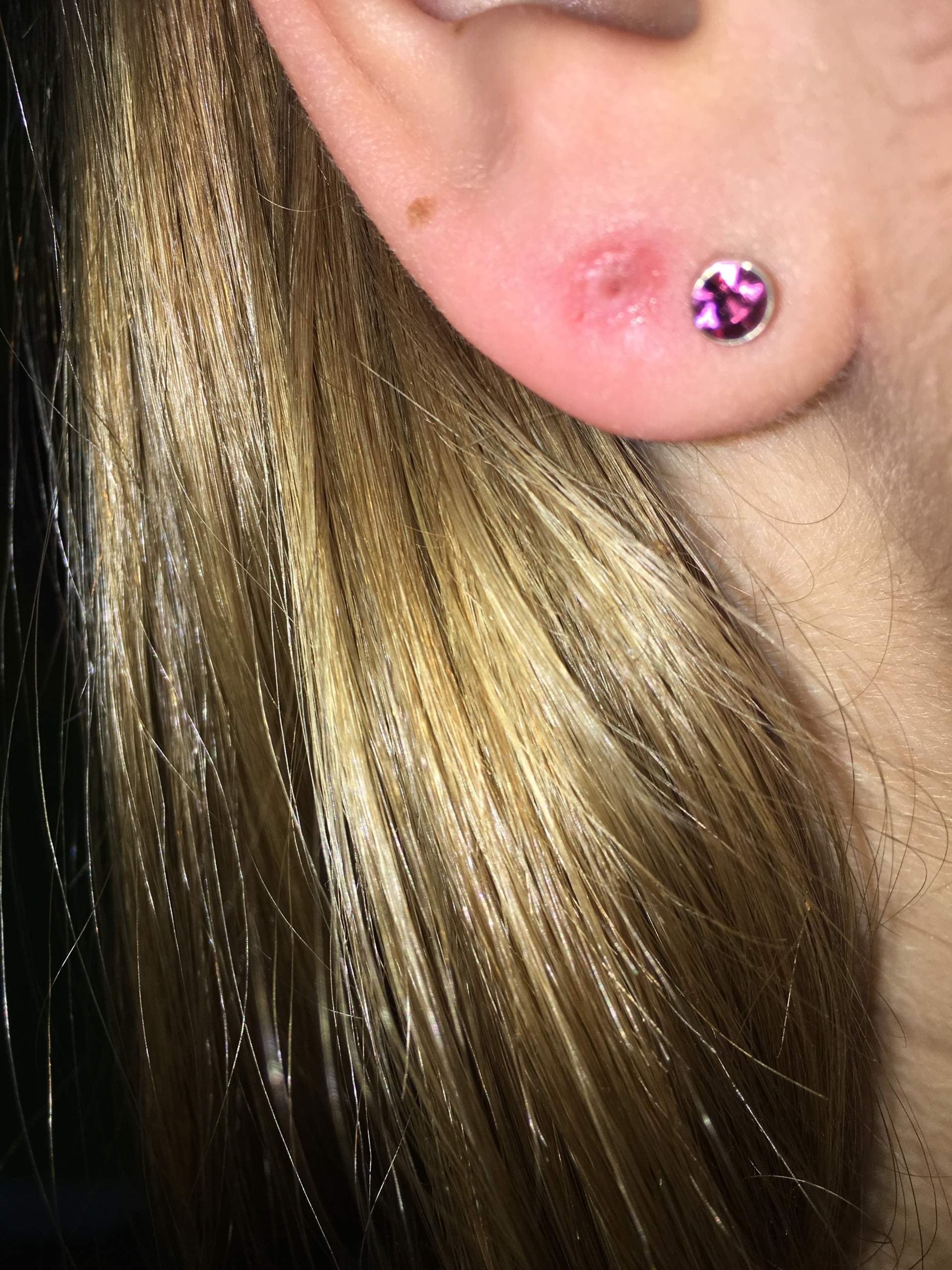 Ohrloch selber gestochen & entzündet? (ohrloch-entzuendet)