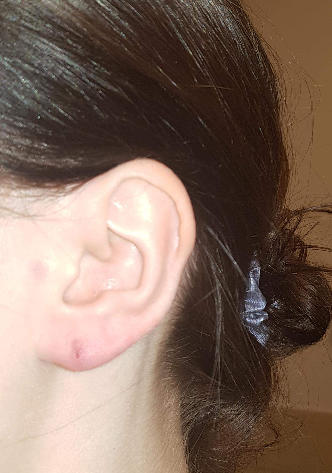 Ohrloch zu tief "gerutscht"? (Piercing)