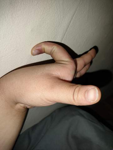 OMG ist das normal was mit meinen Fingern ist?