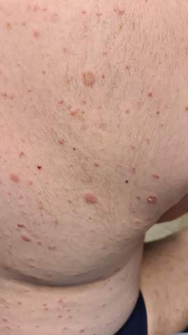 Mann Hat Ungeklarter Hautausschlag Am Ganzen Korper Gesundheit Und Medizin Hautarzt Mann Hat Ungeklarter Hautausschlag Am Ganzen Korper Gesundheit Und Medizin Hautarzt