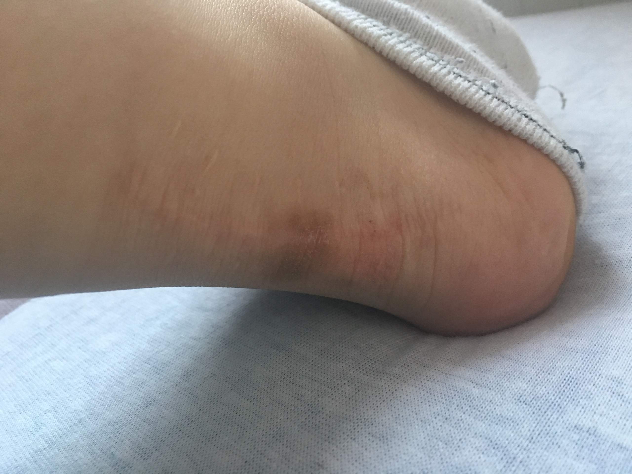 OP Narbe wird blau, woran liegt das? (Operation, Narben)