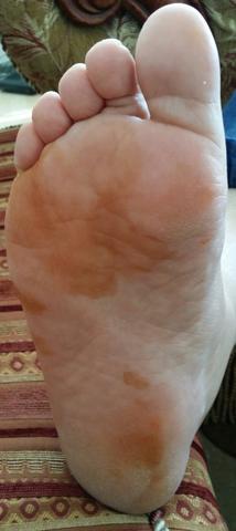 Fuß - (Krankheit, Haut, Füße)