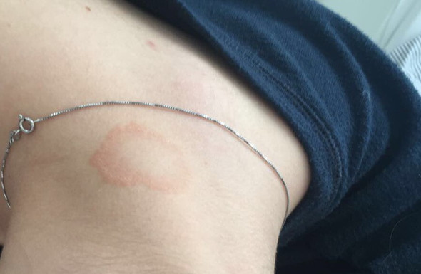 Diesen Fleck gibt es auch nocheinmal in kleiner und ausgefüllt. - (Haut, Flecken, Hautprobleme)