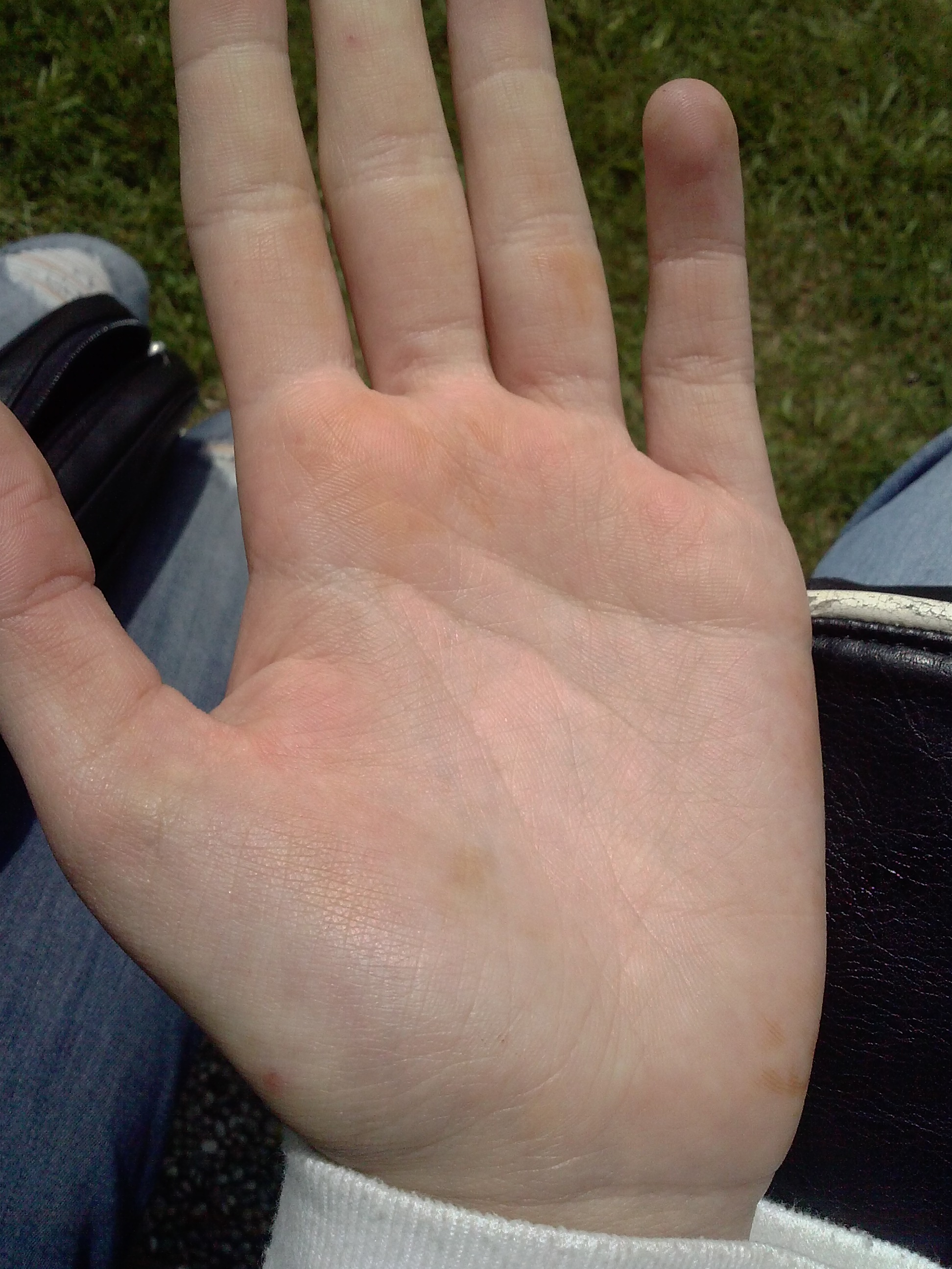 Orangene Flecken (Krankheit, Hand) Orangene Flecken (Krankheit, Hand)