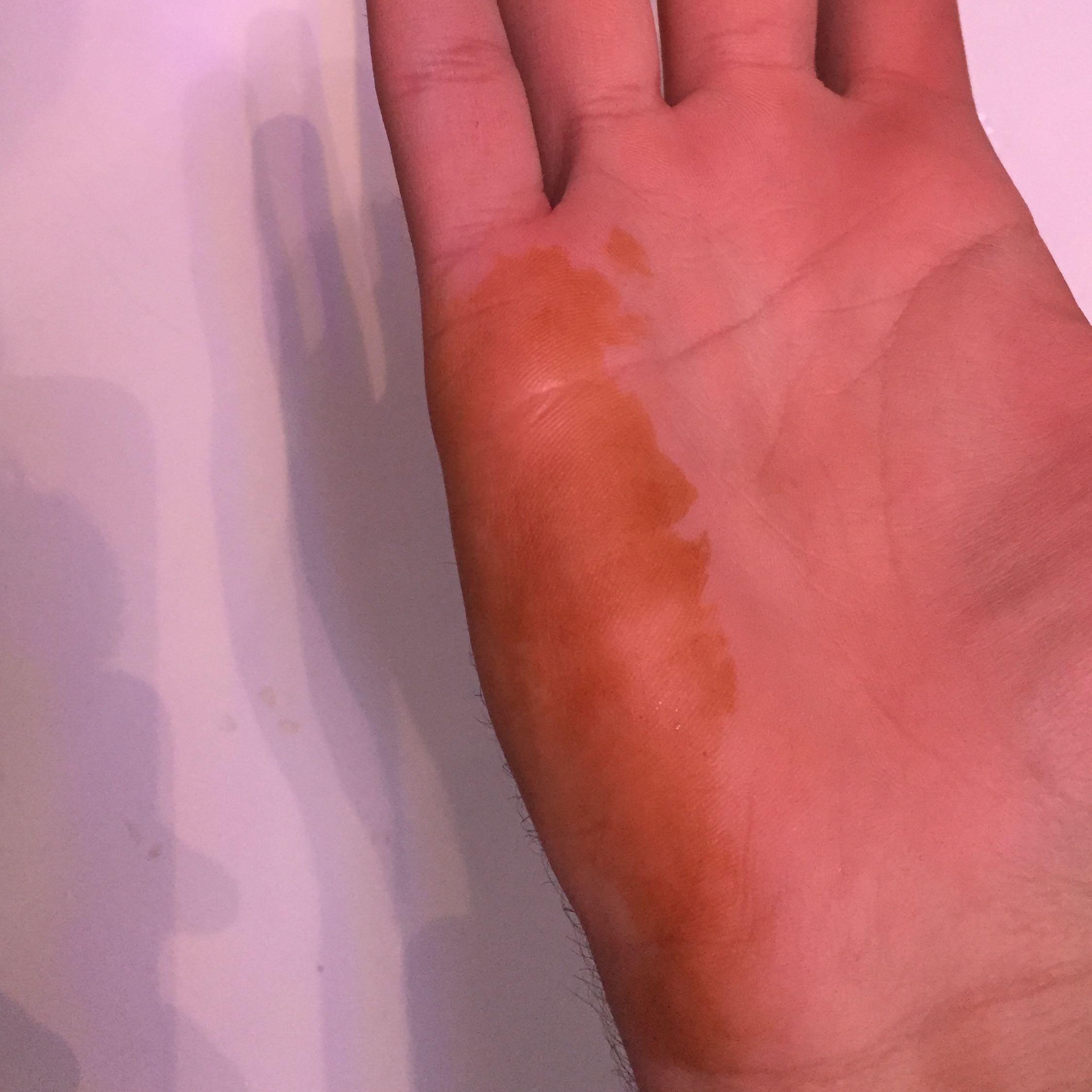 Orangene Verfärbung der Haut, was tun? (Gesundheit)