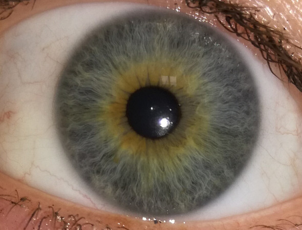 Gemischte Augenfarbe Bedeutung