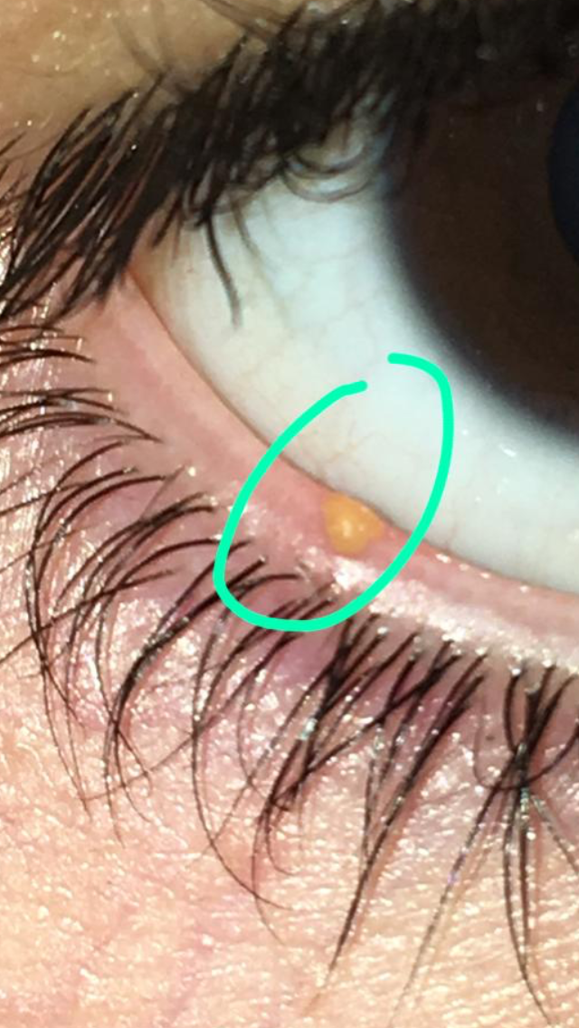 Oranger Fleck Aufm Auge Augen Oranger Fleck Aufm Auge Augen