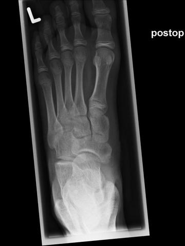 Accessory Navicular Syndrome