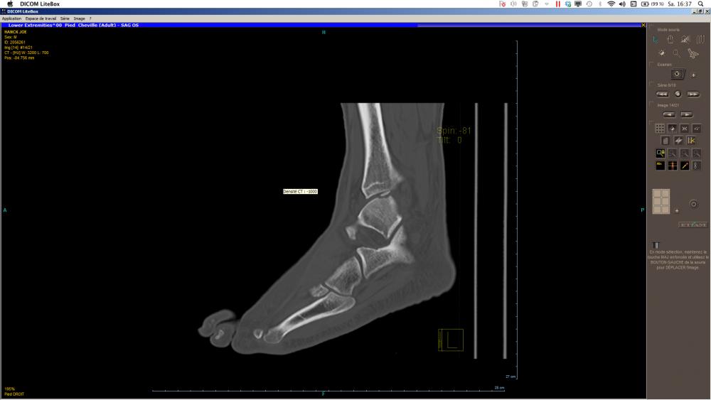 Osteochondrosis dissecans Nie wieder Sport? Heilungschancen und Dauer