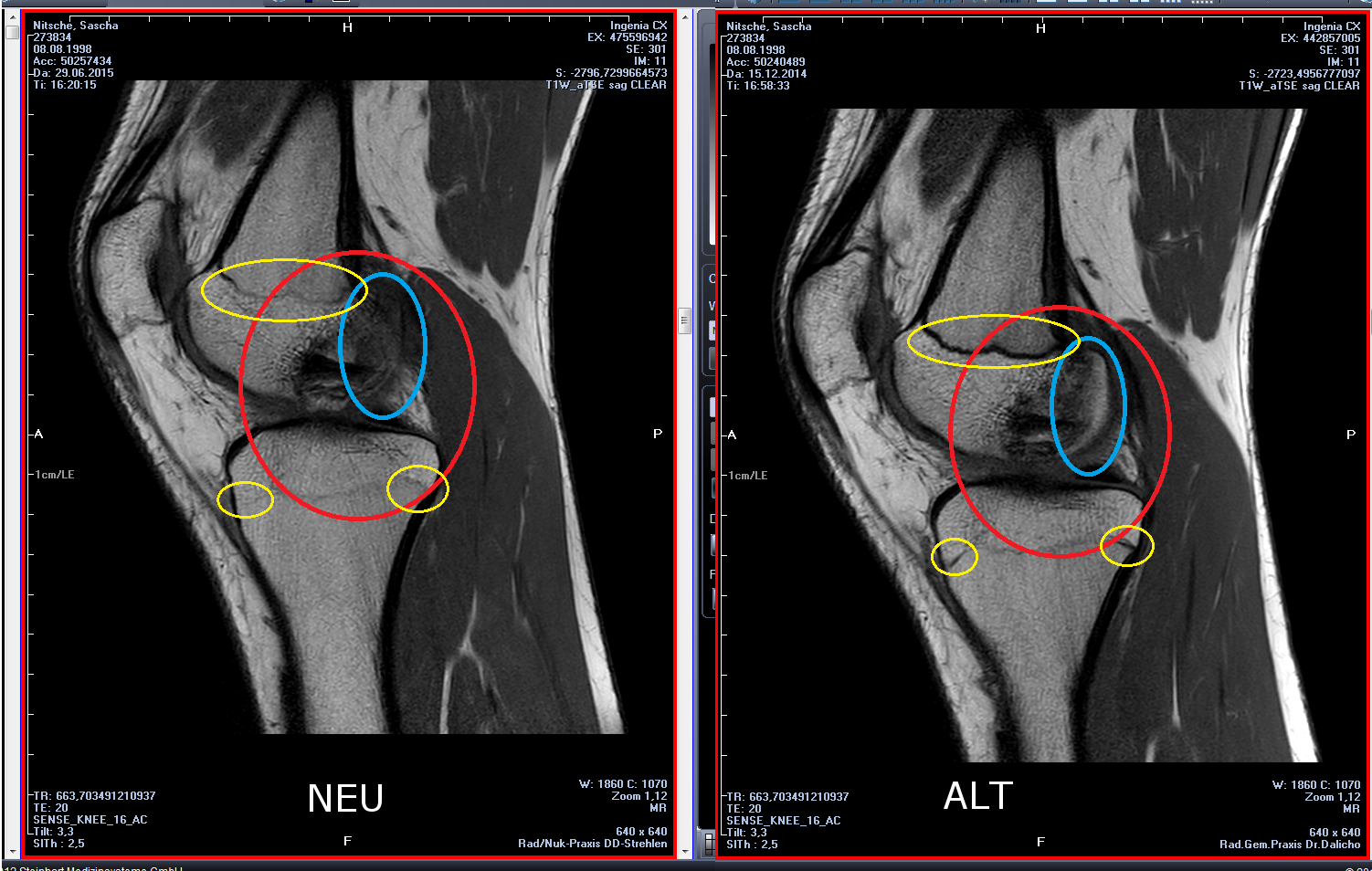 Wie schlimm ist eine Osteochondrosis dissecans? (Medizin, Arzt, Krankheit)