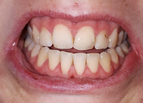 Parodontitis? Wie weit vorangeschritten? (Zähne, Zahnarzt)