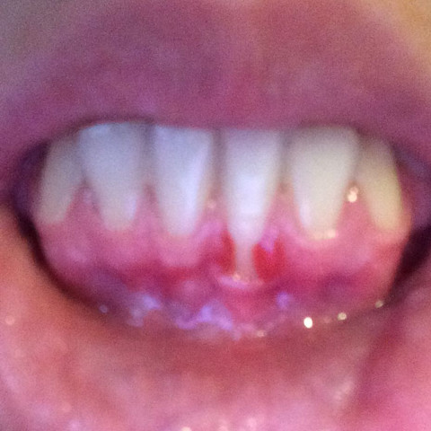 Das Bild entstand nach dem Zähneputzen, daher ein wenig mehr gerötet als sonst.. - (Zähne, Entzündung, Parodontose)