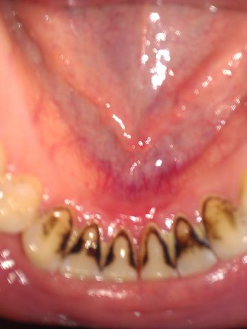 unterkiefer zähne - (Krankheit, Zähne, Mund)
