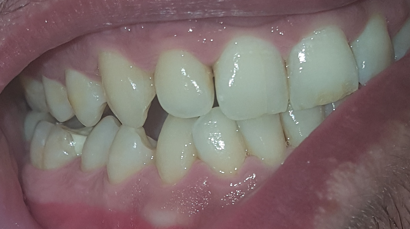 Parodontosebehandlung Wirklich Notwendig Bild Gesundheit Und Medizin Gesundheit Zahnarzt Parodontosebehandlung Wirklich Notwendig Bild Gesundheit Und Medizin Gesundheit Zahnarzt