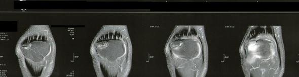 patella bipartita ohne kontrastmittel - (Gesundheit, Operation, Knie)