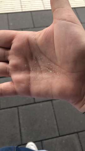 Pellende Haut An Der Hand Dermatologie Medizinisch Pellende Haut An Der Hand Dermatologie Medizinisch