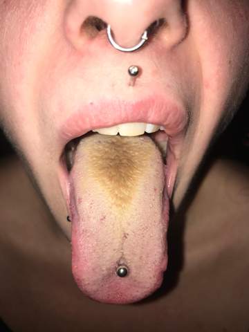 Zungenbelag brauner Belegte Zunge