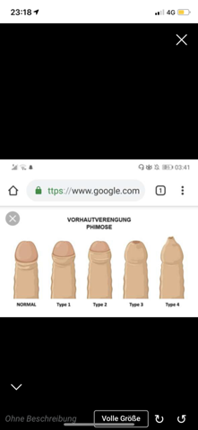 Empfindlich vorhaut Beschneidung für