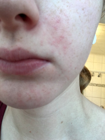 Periorale Dermatitis Behandlungsdauer Hauterkrankung Periorale Dermatitis Behandlungsdauer Hauterkrankung