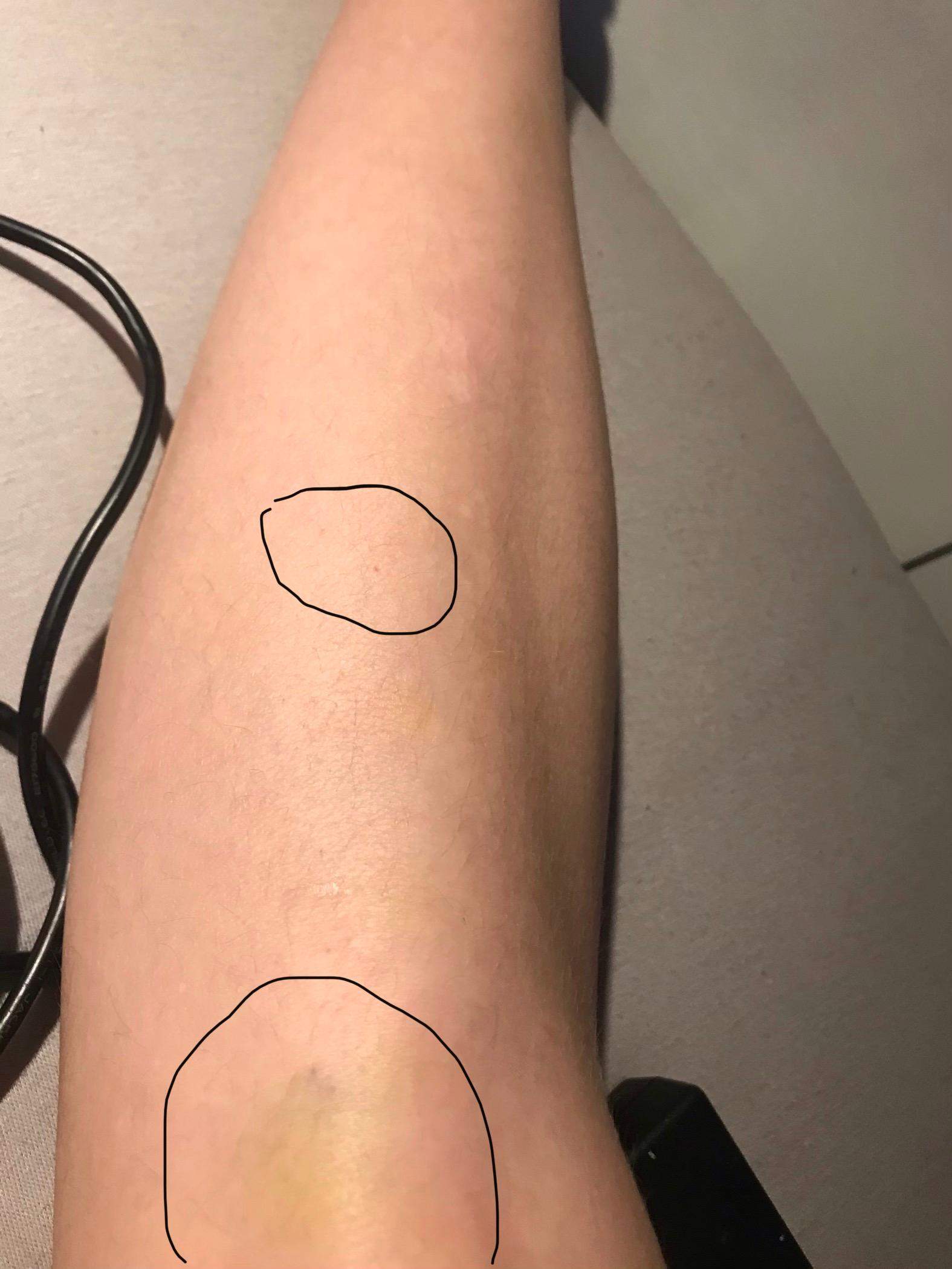 Petechien am Bein und arm (Leukämie)? (Gesundheit und Medizin, Krebs)