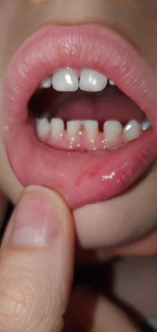 50+ Pickel Im Mund Kind Background