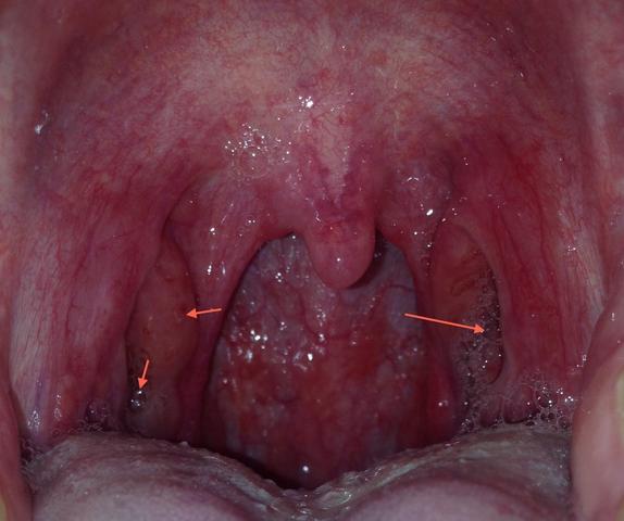 Pfeifferschen Drusenfieber Dauer Der Erkrankung Gesundheit Krankheit Gesund Pfeifferschen Drusenfieber Dauer Der Erkrankung Gesundheit Krankheit Gesund
