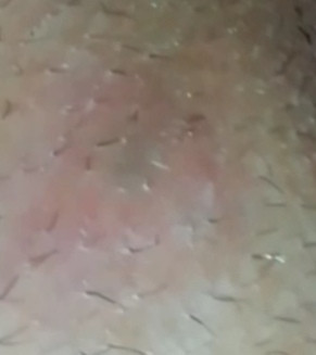 Pickel Kleine Pickel An Vagina Und Beinen Was Kann Ich Dagegen Tun Gesundheit Und Medizin Schmerzen Pickel Kleine Pickel An Vagina Und Beinen Was Kann Ich Dagegen Tun Gesundheit Und Medizin Schmerzen