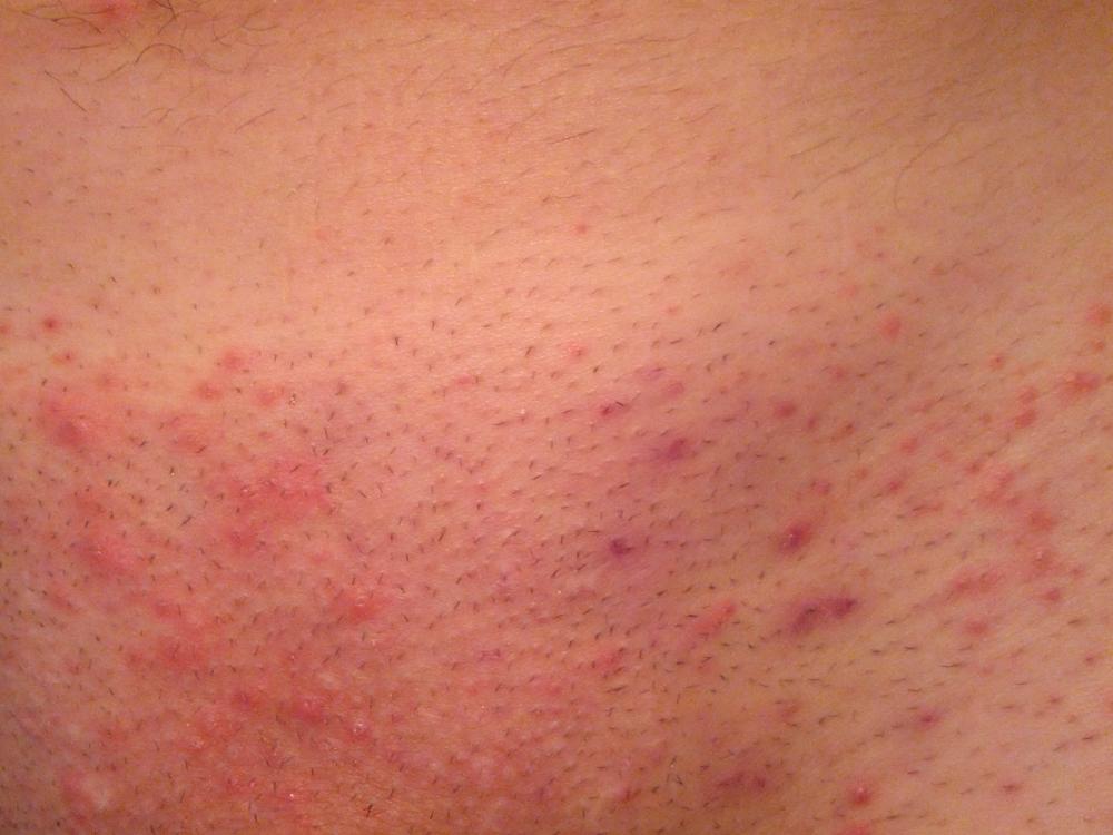 Nichts ist unangenehmer als rote Punkte, Pickel und Rasurbrand im Intimbereich daher sollte Nichts ist unangenehmer als rote Punkte, Pickel und Rasurbrand im Intimbereich daher sollte
