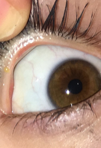 Pickel Am Auge Oder Krankheit Augen