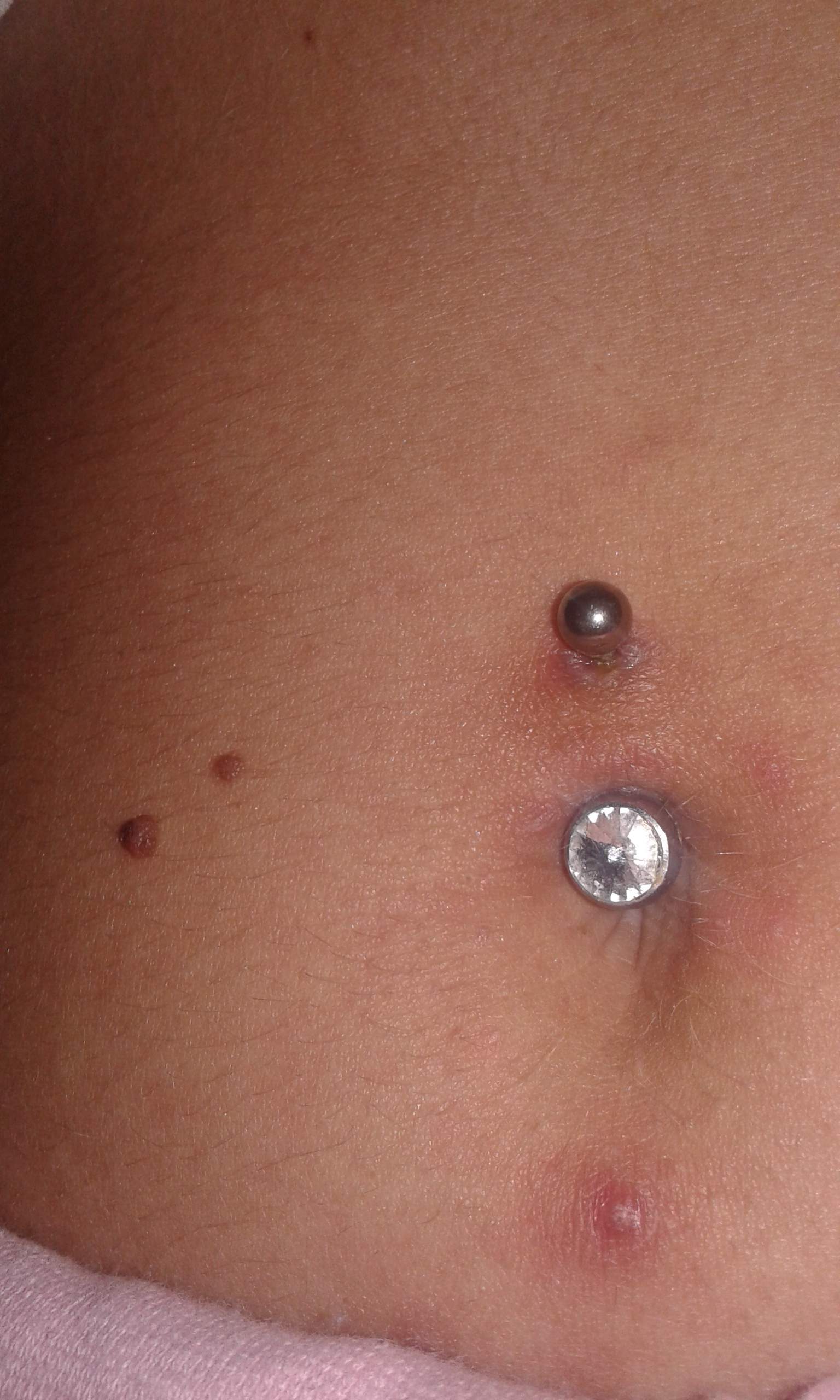 Was Tun Gegen Wildfleisch Am Bauchnabelpiercing
