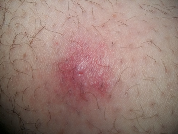 Pickel am beim? (Entzündung) pickel entzündung