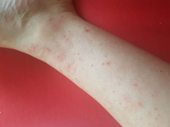 pickel am fussgelenk hautprobleme