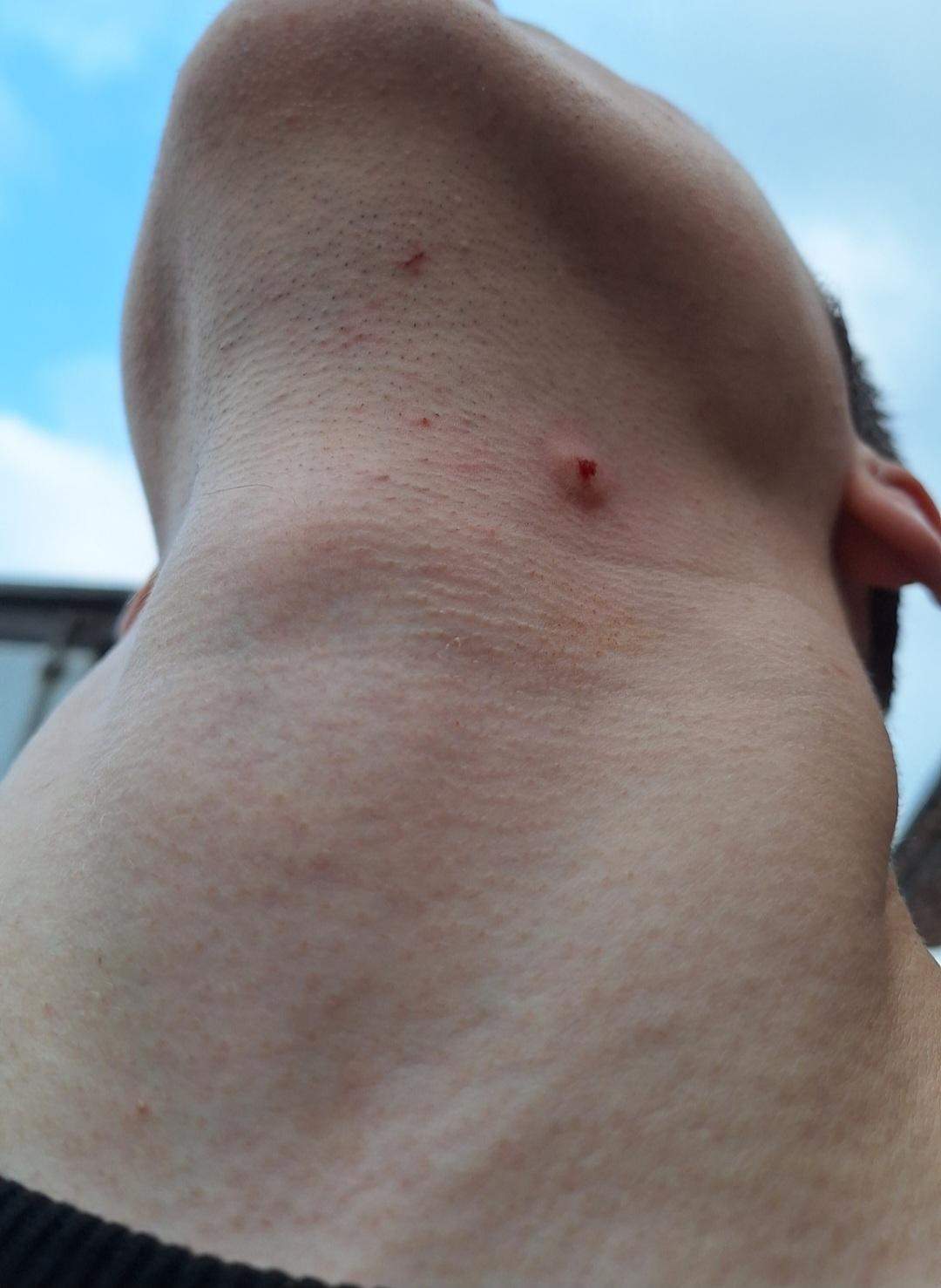 Schne Verkapselte Pickel Am Hals Fotos