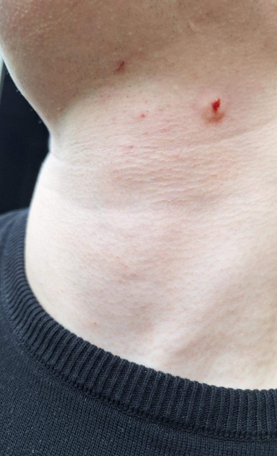 Schne Verkapselte Pickel Am Hals Fotos