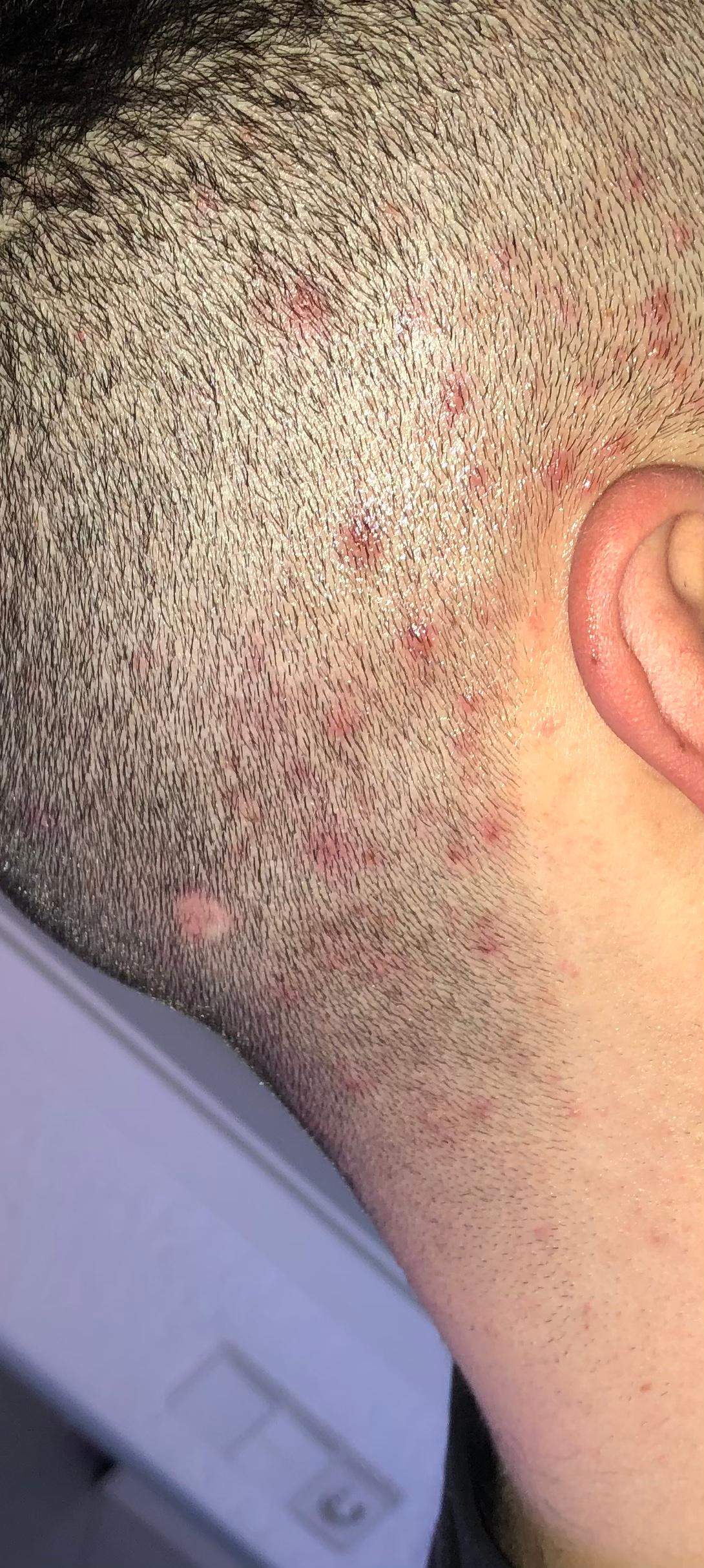 Pickel am Hinterkopf? (Gesundheit und Medizin, Beauty, Krankheit) pickel hinterkopf