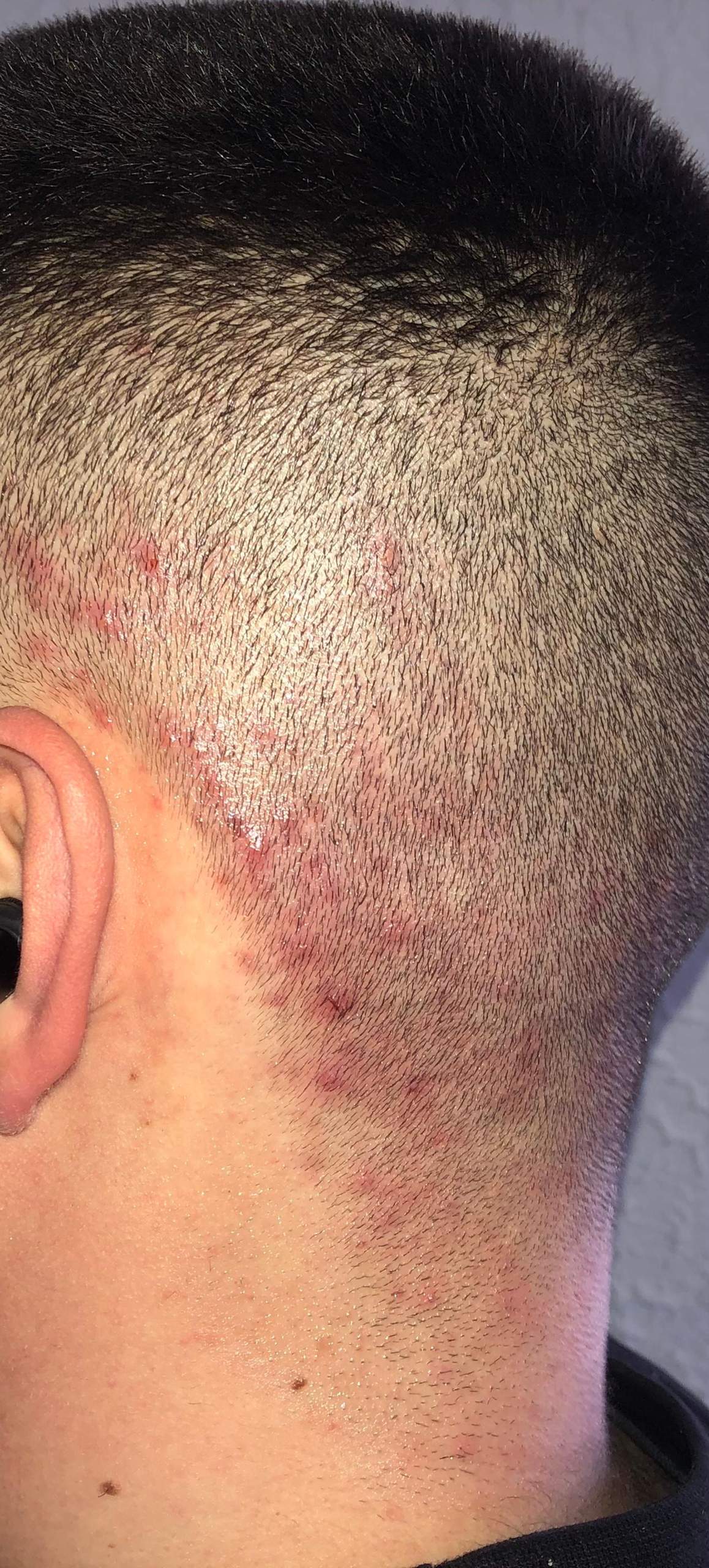 Pickel am Hinterkopf? (Gesundheit und Medizin, Beauty, Krankheit) pickel hinterkopf