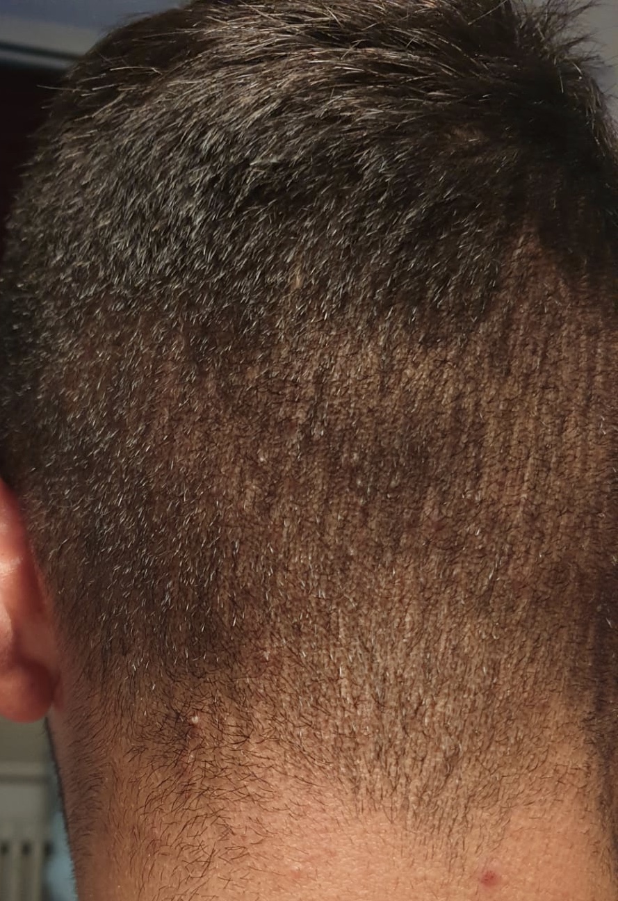 Pickel Am Hinterkopf Hilfee Haare Haut Kopf Pickel Am Hinterkopf Hilfee Haare Haut Kopf