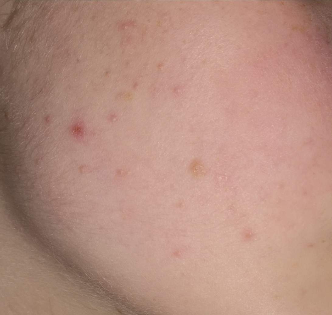 Pickel am Kiefer? (Gesundheit und Medizin, Beauty, Haut) pickel am kiefer