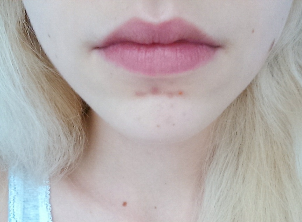 Pickel am Kinn gehen nicht mehr weg? (Mittel, Anti) pickel auf kinn