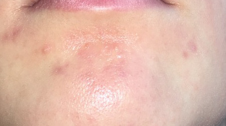 pickel kinn ursache pickel kinn ursache