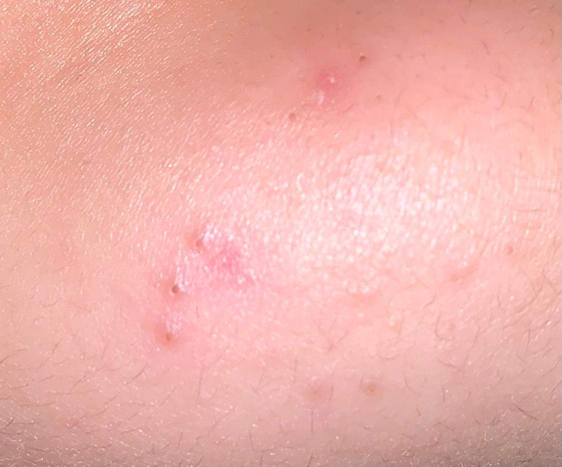 Pickel am Kinn loswerden wie? (Gesundheit und Medizin, Haut, Akne)