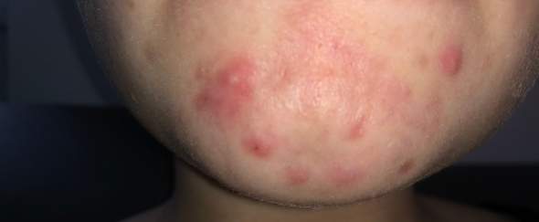 View Pickelmale Kinn Pics