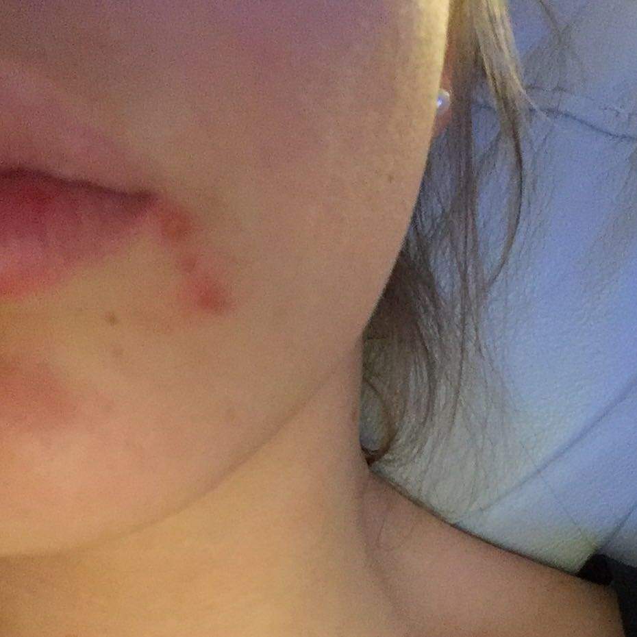 können hunde pickel bekommen