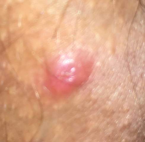 Pickel Am Penis Haut Pubertat Intimbereich Pickel Am Penis Haut Pubertat Intimbereich