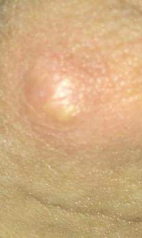 Pickel Am Penis Pickel Am Penis