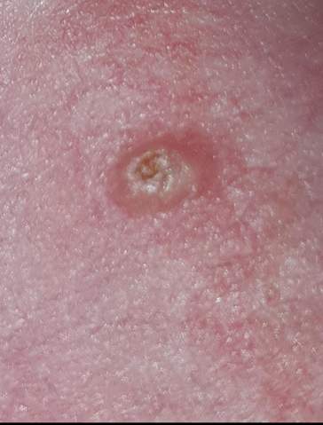 Pickel Am Penis Was Kann Das Das Sein Krankheit Pickel Am Penis Was Kann Das Das Sein Krankheit