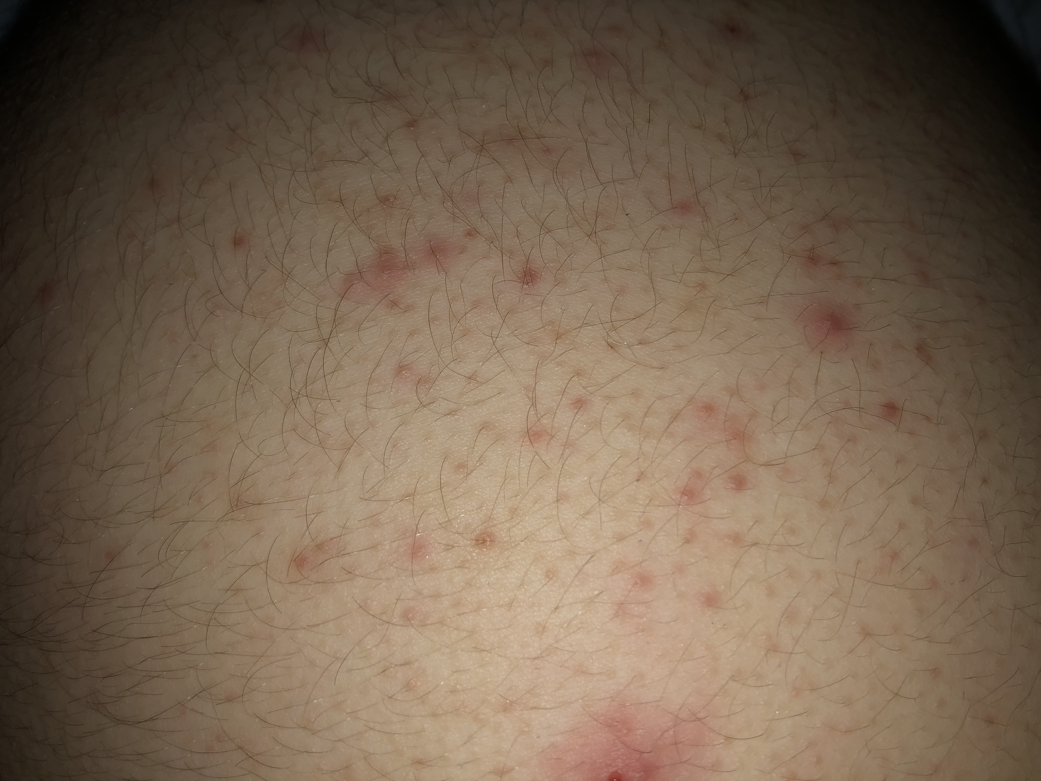 Pickel am Po warum? (Gesundheit und Medizin, Pubertät) pickel auf dem po