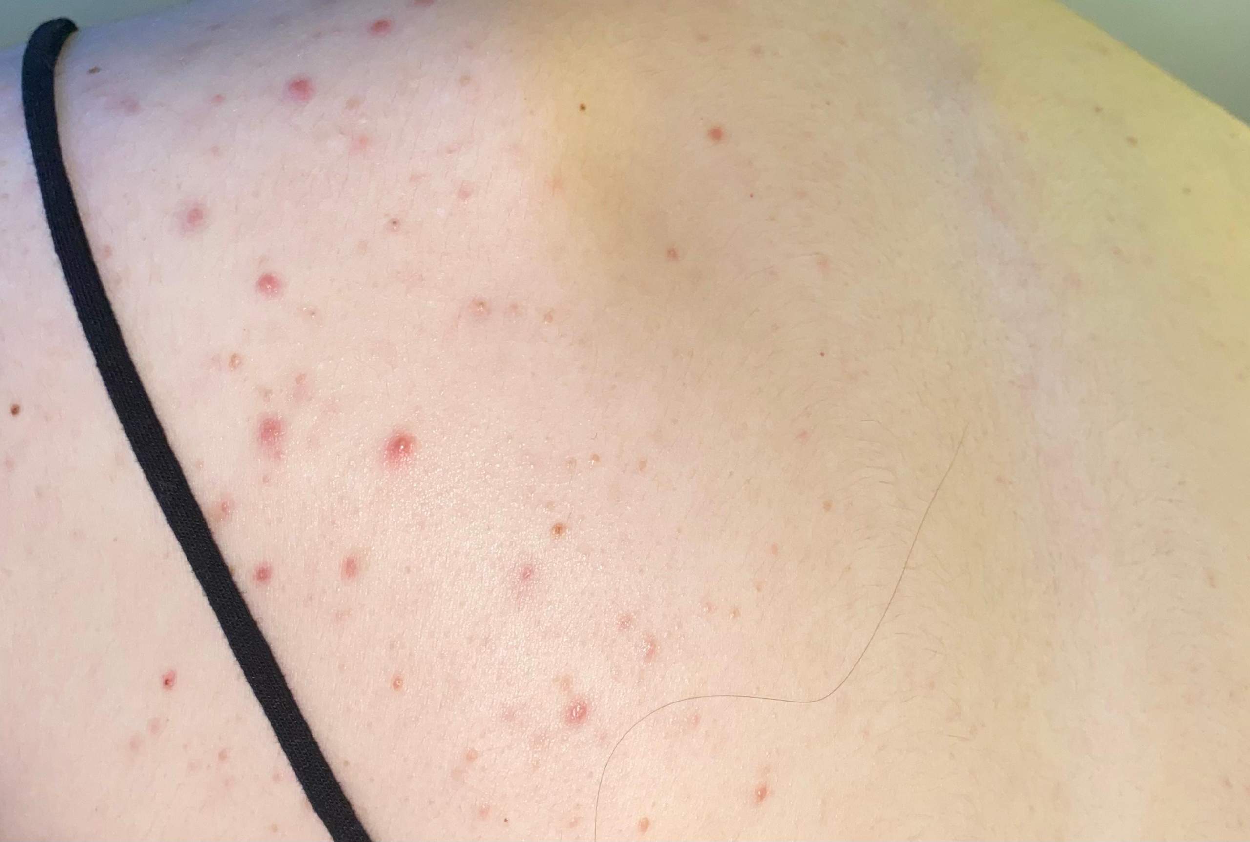 pickel am rücken hormone pickel am rücken hormone